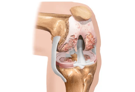 Arthrose oder Arthritis der Unterschiede