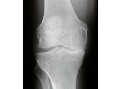 Diagnose der Arthrose des Kniegelenks