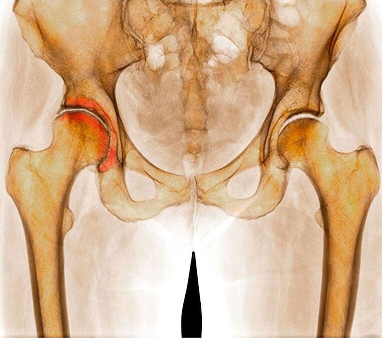 Arthrose des Hüftgelenks