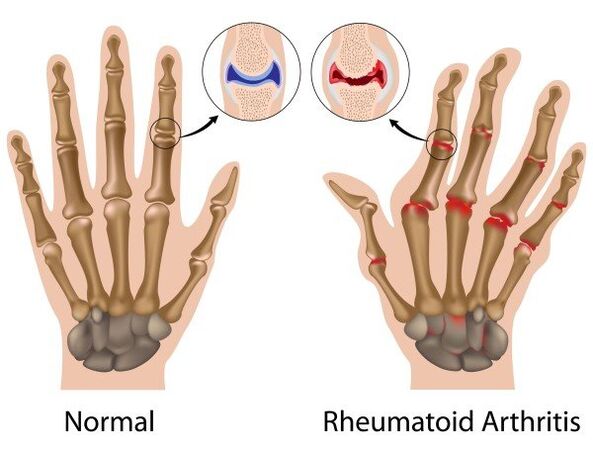 DITA -Gelenke ohne Pathologie und mit rheumatoider Arthritis