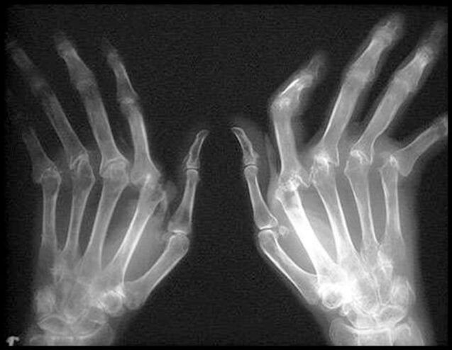 Quad -Verfahren von Händen, die von Arthrose betroffen sind