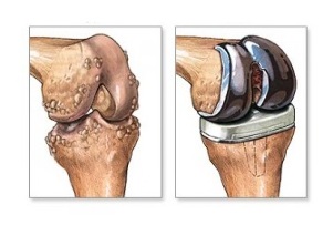 Knieersatz bei Arthrose