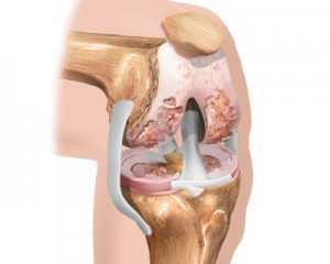 das Anfangsstadium der Knie-Arthrose