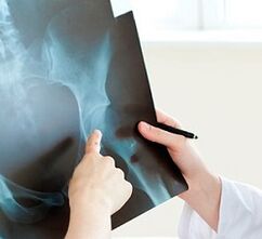 Wie man die Arthrose des Hüftgelenks behandelt