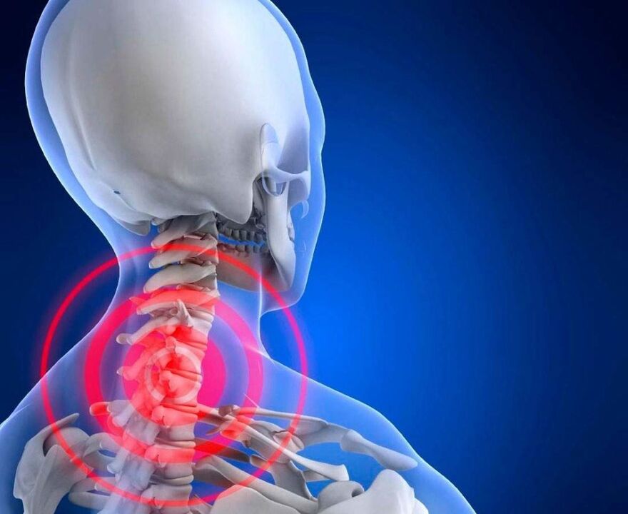 Nackenschmerzen mit zervikaler Osteochondose