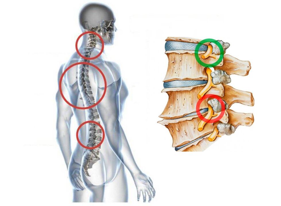 Wie die zervikale Osteochondose der Wirbel erscheint