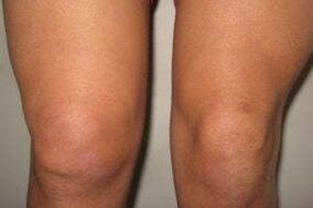 Entzündung des Kniegelenks mit Arthritis und Arthrose