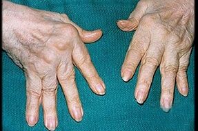 Symptome einer Arthritis in den Fingern