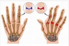 Unterschiede zwischen Arthritis und Arthrose der Hände