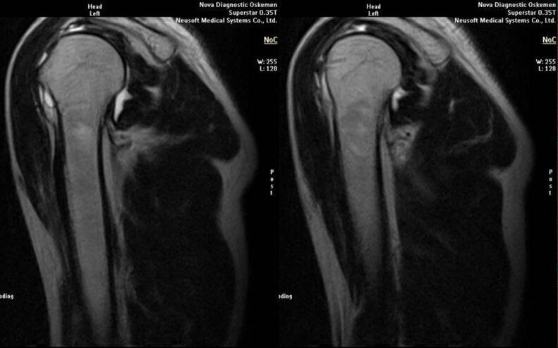 Arthrose des Schultergelenks im Röntgenbild