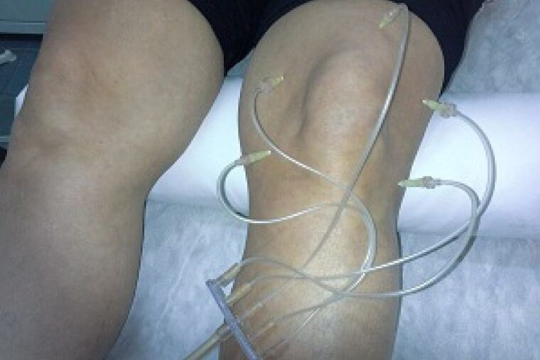 Ozontherapie
