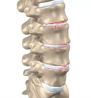 Osteochondrose